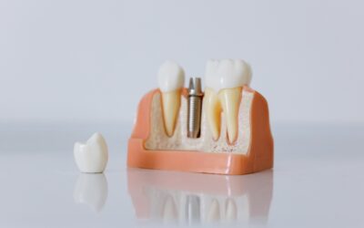 The Advantages of Dental Implants Over Traditional Dentures: Why I Recommend Them to My Patients